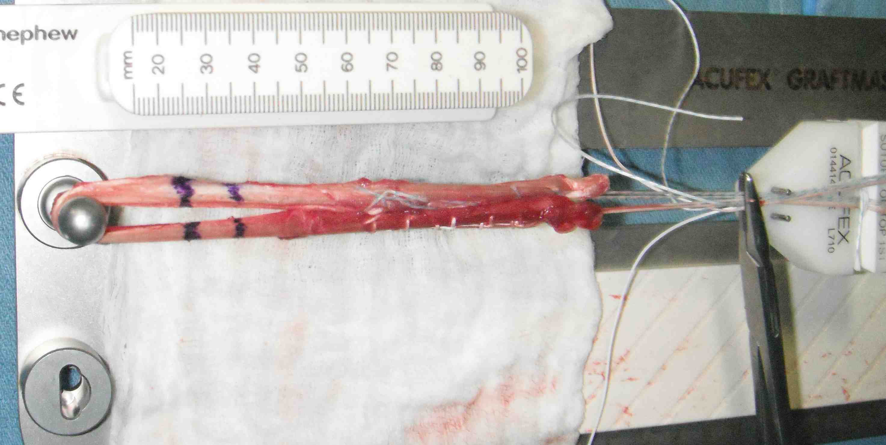 Hamstring Graft Tensioned